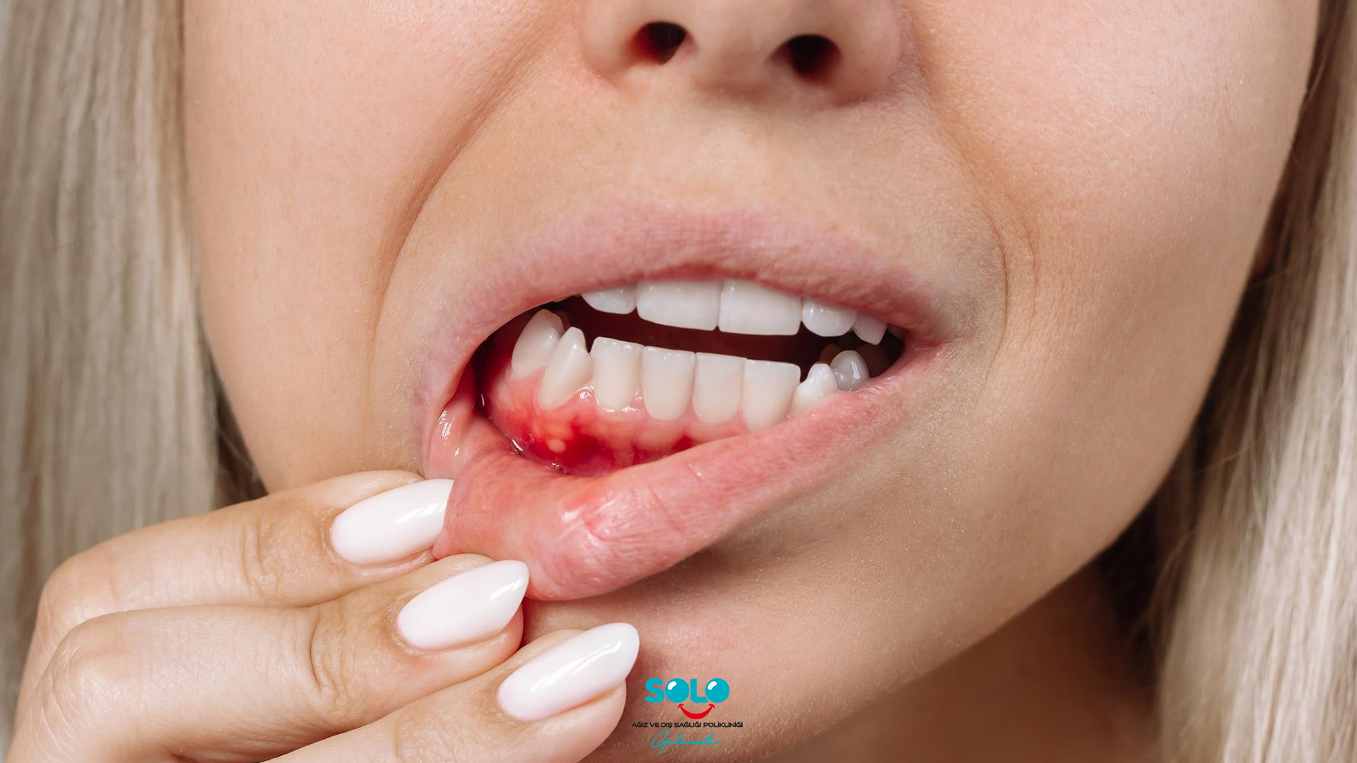 చిగుళ్ల నుంచి రక్తం కారుతోందా.. ఈ చిట్కాలు పాటిస్తే మాత్రం సమస్య సులువుగా దూరం!