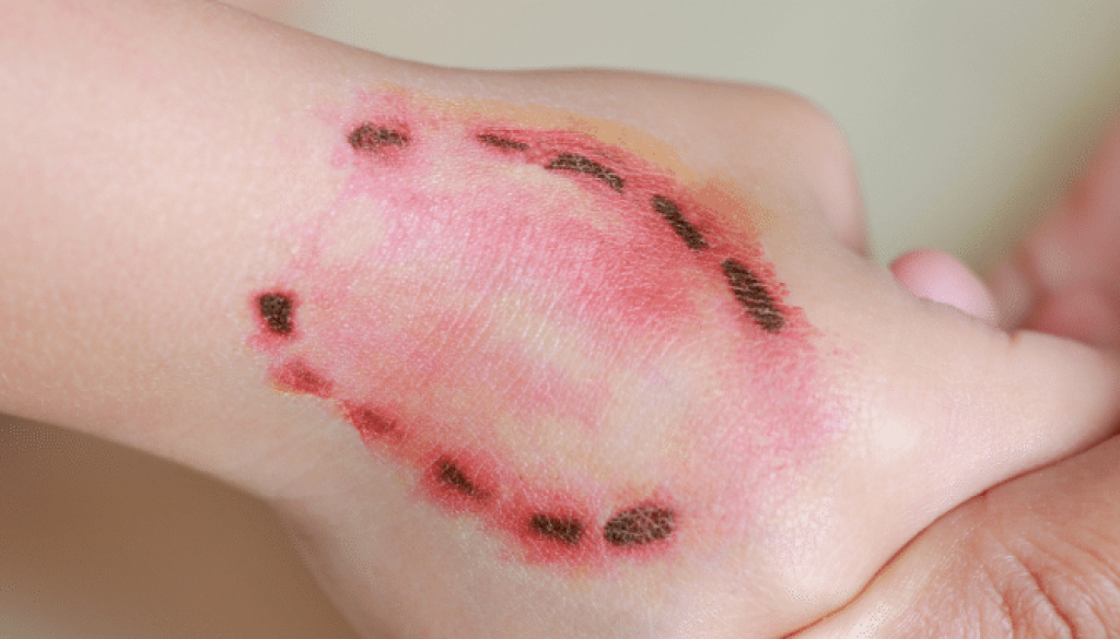 కుక్క కరవడం వల్ల ఇబ్బందులు పడుతున్నారా.. కచ్చితంగా పాటించాల్సిన చిట్కాలివే!