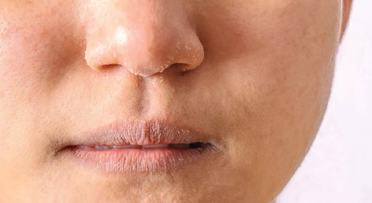 మీ చర్మం తరచూ పొడి బారుతోందా.. ఈ లోపం ఉంటే ఆ సమస్యలు వచ్చే ఛాన్స్!