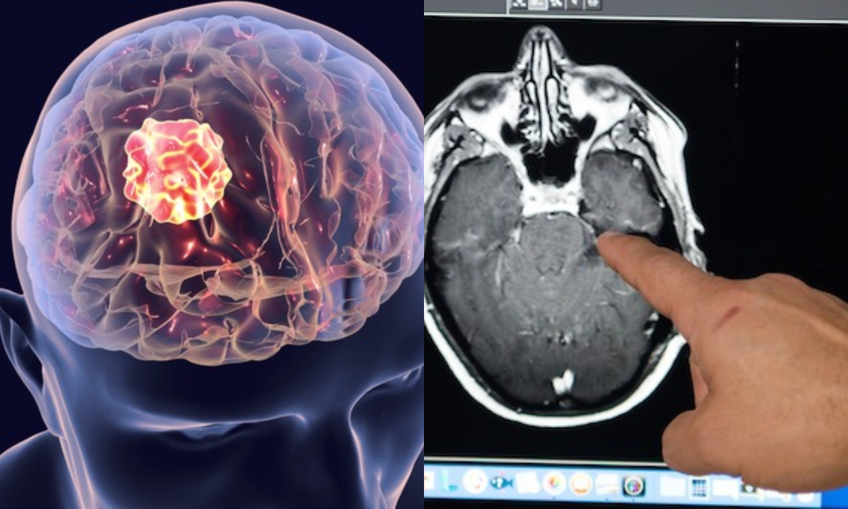 Brain Tumor: బ్రెయిన్ ట్యూమర్ ఎవరికీ ఎక్కువగా వస్తుందో మీకు తెలుసా..?