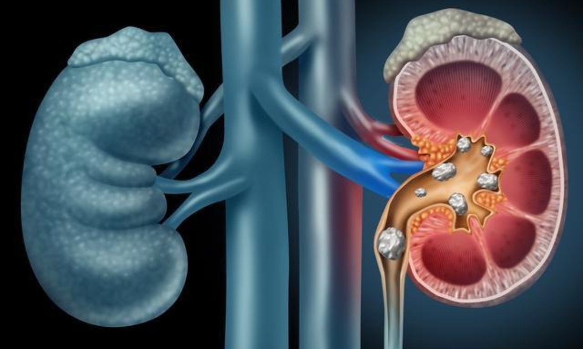 Kidney: కిడ్నీలో రాళ్లు.. మందులు లేకుండా ఇలా తగ్గించుకోవచ్చు..!